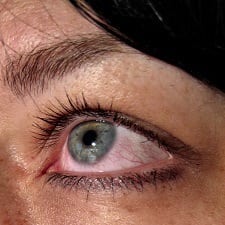 dry eyes and allergies